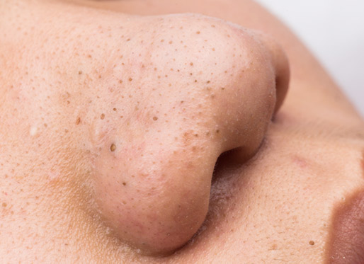 blackhead