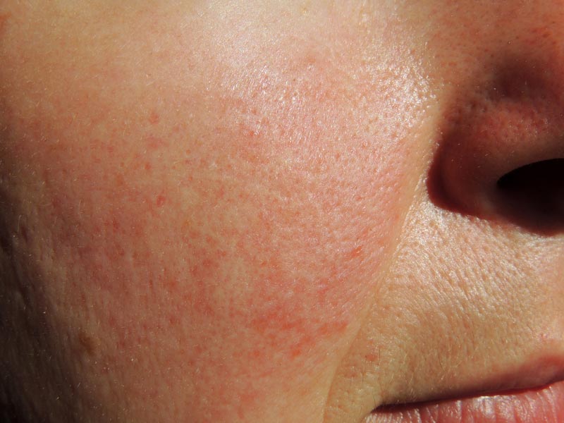 Rosacea info
