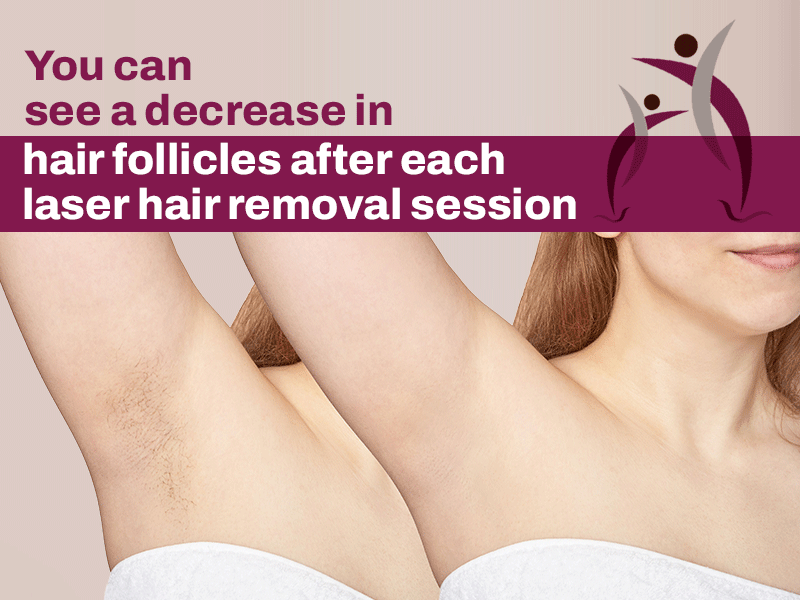 Is Laser Hair Removal a Permanent Solution? - Listen from the Dermatologist 3 Hair Follicles are reduced after each laser hair removal session