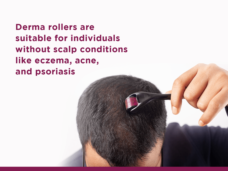 The Benefits of Using a Derma Roller for Hair Loss 4 Derma rollers are suitable for scalp conditions