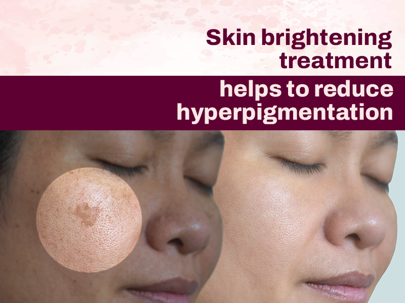 Skin Brightening Treatment- A Must for Wedding Seasons 3 Skin Brightening Treatment Reduces Pigmentation