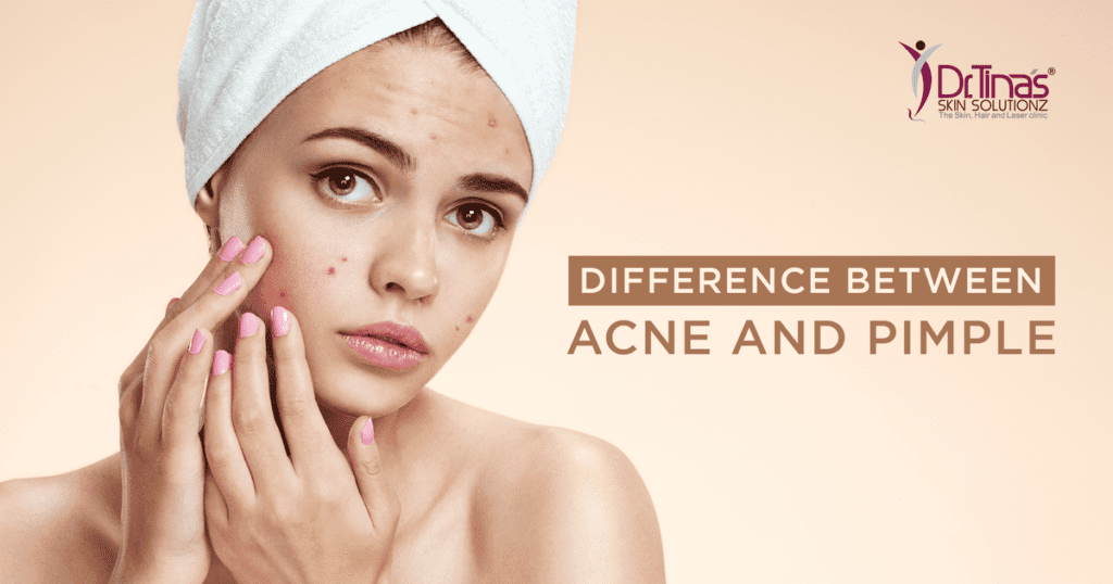 Acne vs Pimples: Do You Know The Differences? 1 Final. Acne vs Pimples Do You Know The Differences
