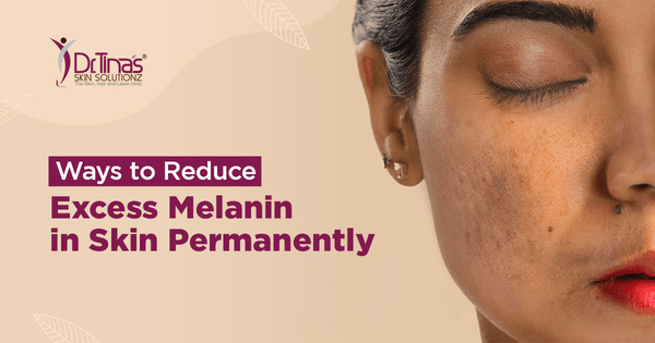 Ways To Remove Pigmentation From Face Permanently 1 Ways to Reduce Excess Melanin in Skin Permanently