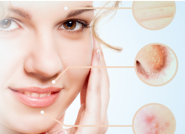 Chemical Peels