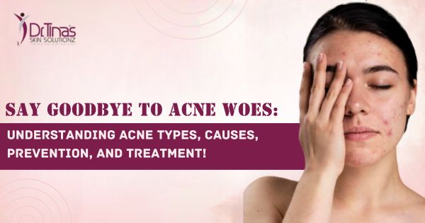 Acne 101: A Comprehensive Guide to Understanding Acne Types, Causes, Prevention, and Treatment! 1 comprehensive guide on acne