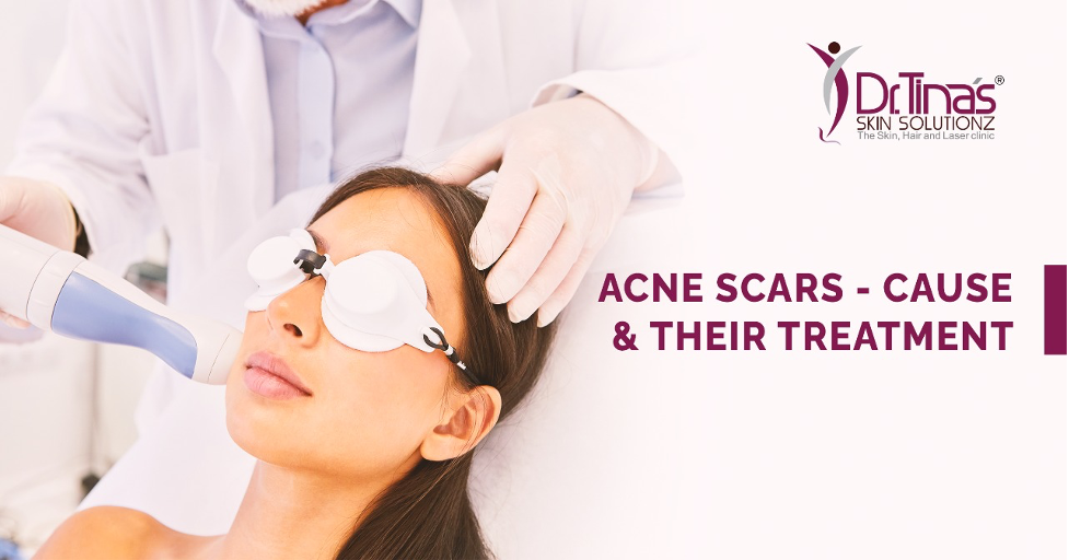 Acne Scars - Causes and Their Treatment 1 Acne Scars Treatment In Bangalore