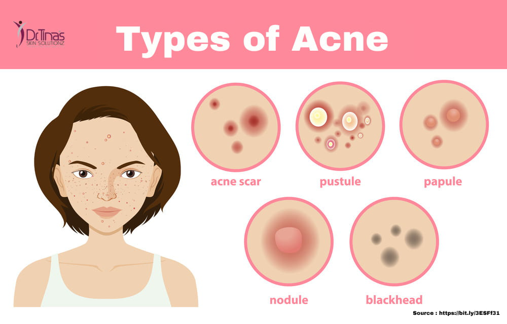 Acne 101: A Comprehensive Guide to Understanding Acne Types, Causes, Prevention, and Treatment! 2 Types of acne