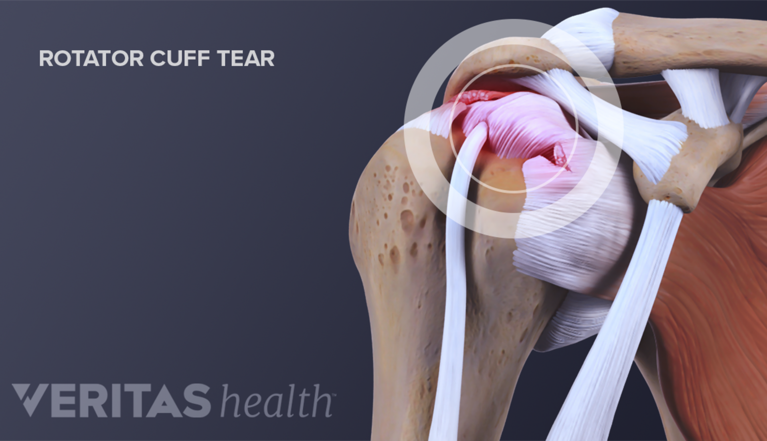 Anterior view of the shoulder joint showing a rotator cuff tear