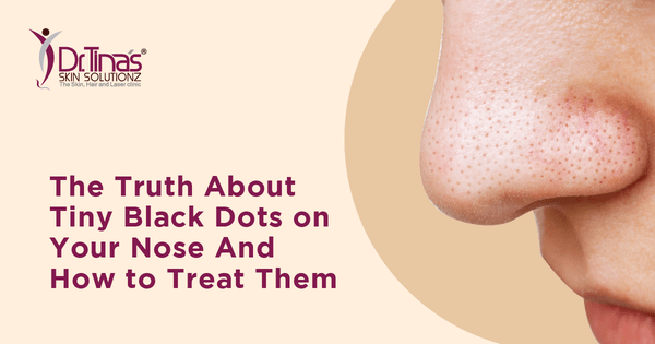 The Truth About Tiny Black Dots on Your Nose and How to Treat Them 1 Truth About Tiny Black Dots on Your Nose