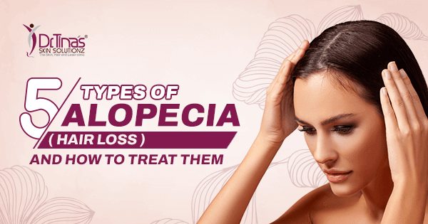 Five Types of Alopecia (Hair Loss) and How to Treat Them 1 5 161222