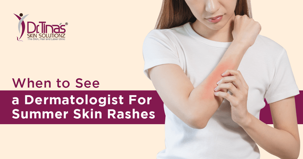 When to See a Dermatologist for Your Summer Skin Rashes 1 When to see a dermatologist for summer skin rashes