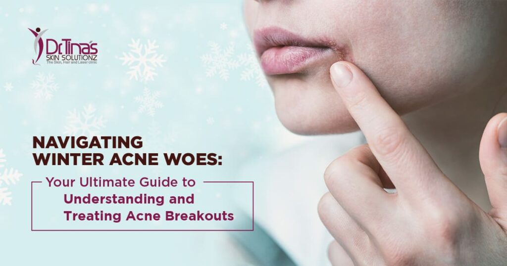 Why Do You Get Acne in Winter? The Ultimate Guide for Winter Acne Breakouts 1 Acne breakout treatment