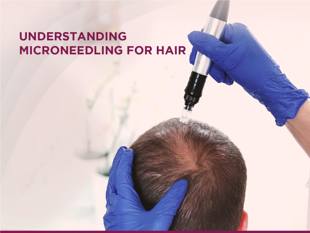 Microneedling for Hair: What to Expect During and After Treatment 2 what is micro-needling