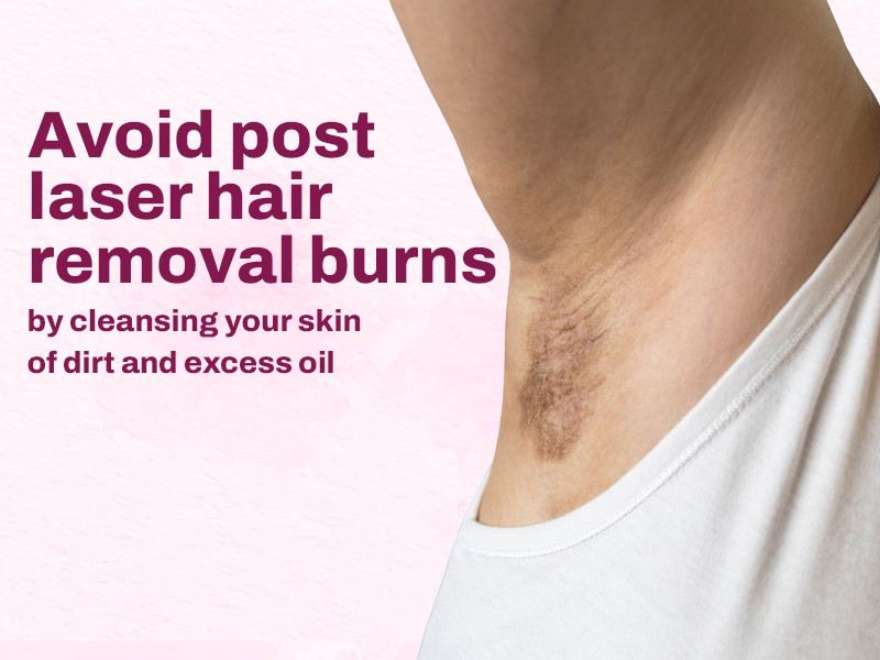 Debunking 5 Popular Myths of Laser Hair Removal for Teenagers 2 Preventing burns during laser hair removal