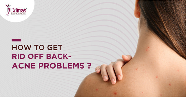 Say Goodbye to Back Acne Scars: Effective Strategies for Treatment 1 Get rid of back acne 1