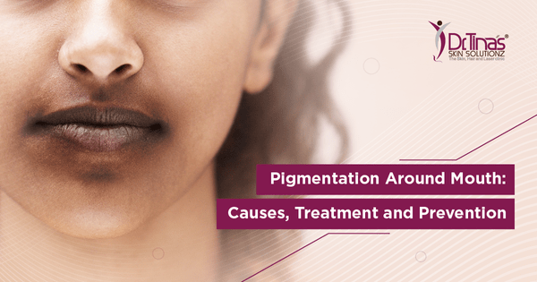 Pigmentation Around Mouth: Causes, Treatment and Prevention 1 Pigmentation Around Mouth: Causes, Treatment and Prevention