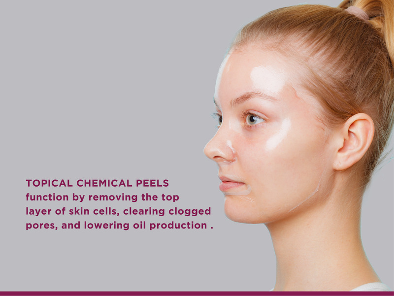 Say Goodbye to Back Acne Scars: Effective Strategies for Treatment 3 Topical chemical peels for controlling back acne