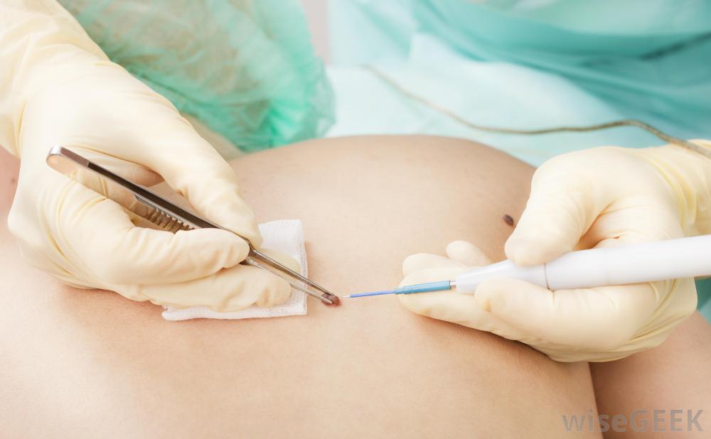 Skin Tag  Treatments