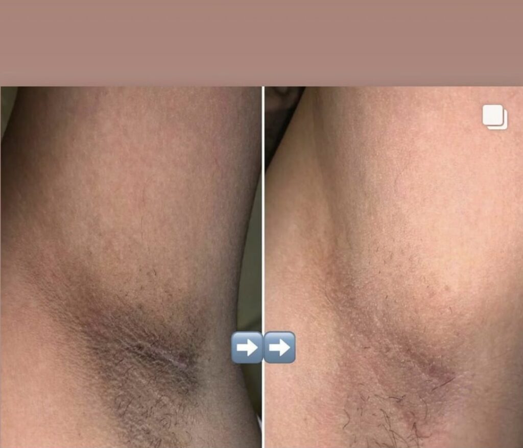 Before and after intimate brightening pics of armpit