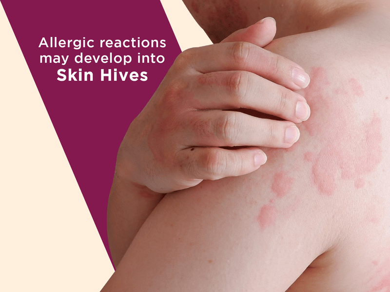 When to See a Dermatologist for Your Summer Skin Rashes 3 Allergic reactions may develop into hives