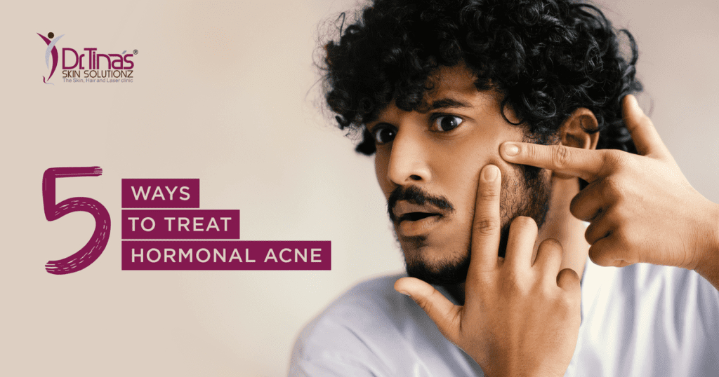 5 Ways to Treat Hormonal Acne 1 5 Ways to Treat Hormonal Acne