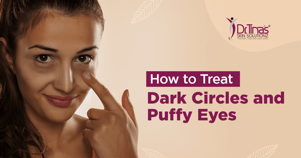 How to Treat Dark Circles and Puffy Eyes 1 How to Treat Dark Circles and Puffy Eyes