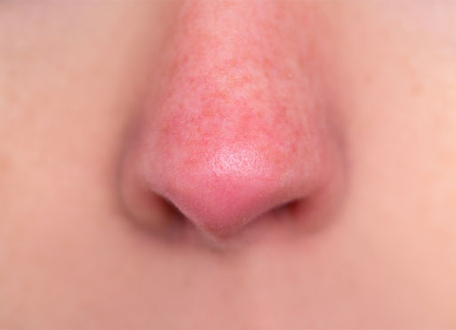 Rosacea