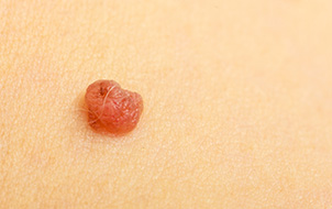 Skin Tag Removal