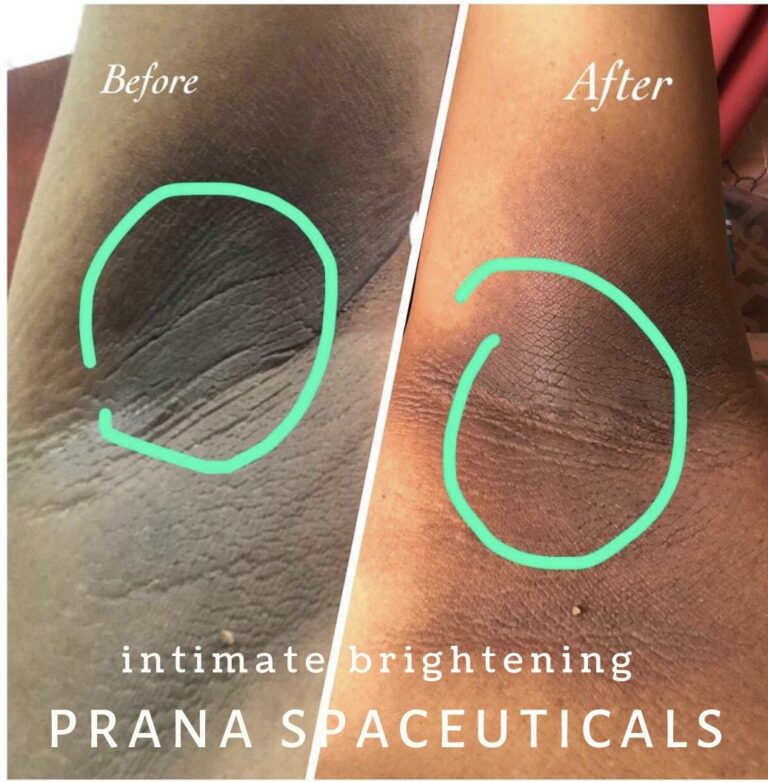 Underarm before and after pics