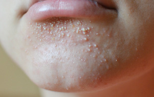 Milia Removal