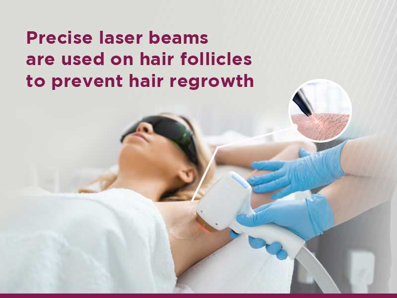 Laser hair removal offers a long-term solution