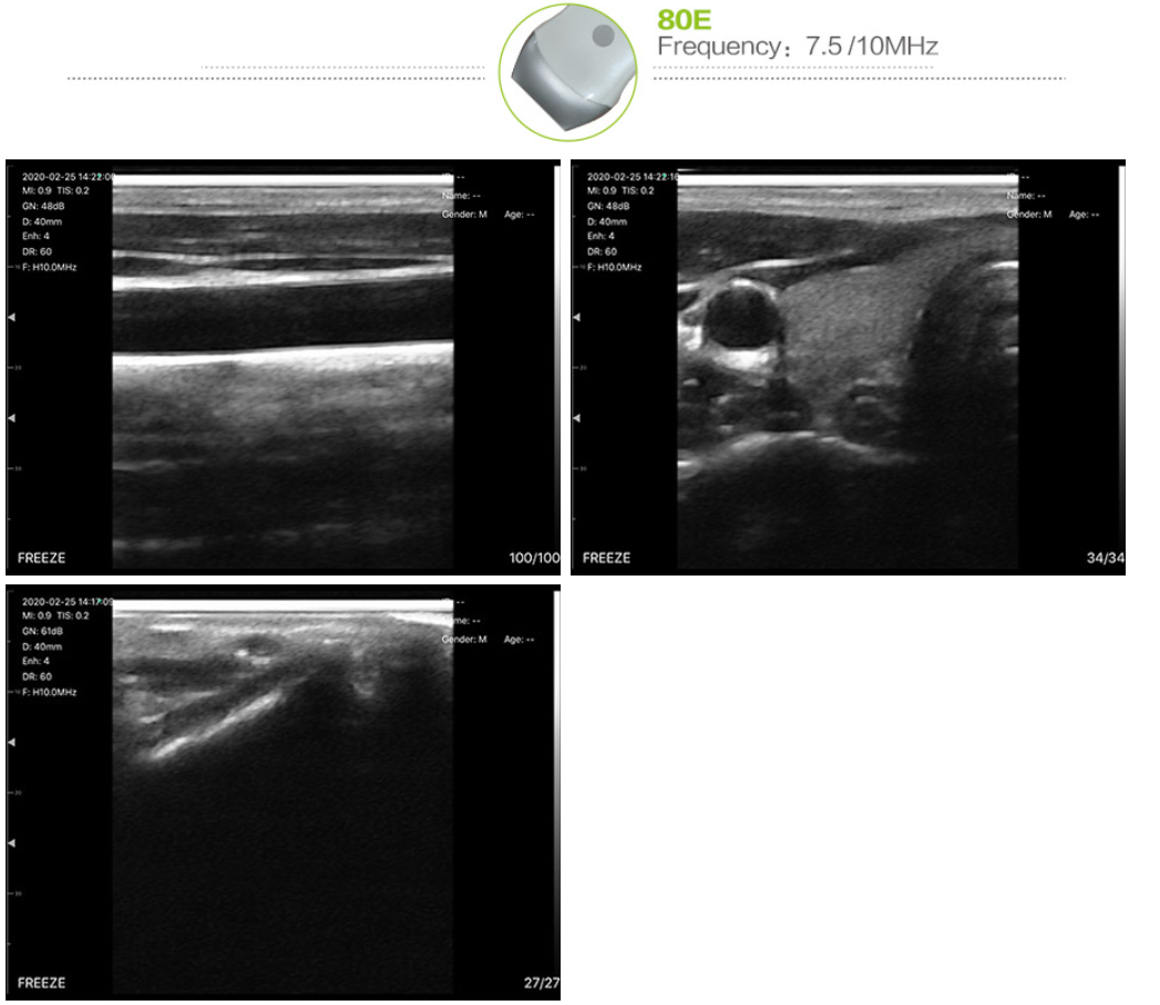 Handheld ultrasound 