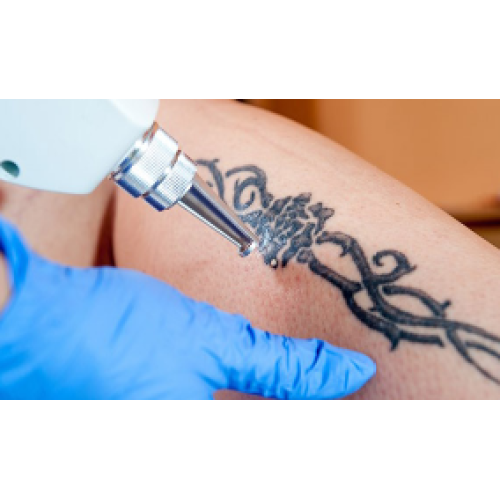 How many treatments does tattoo removal take? | Choicy Beauty- a beauty training academy