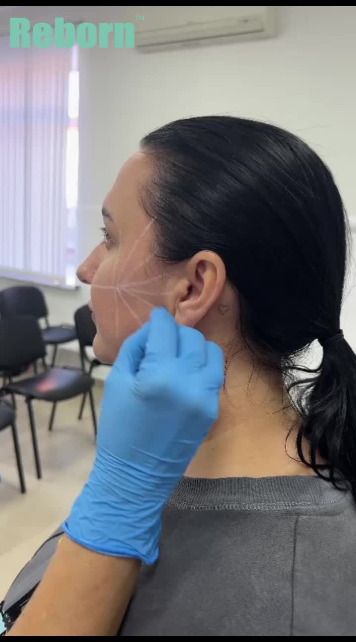 Design Scheme on Cheek Before Injection