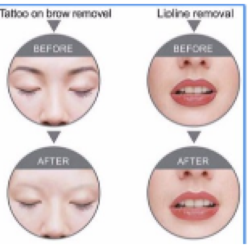 Laser cosmetic treatment problem | Choicy Beauty- a beauty training academy