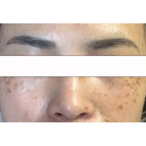 Nevus Fusco-caeruleus Zygomaticus Treatment | Choicy Beauty- a beauty training academy