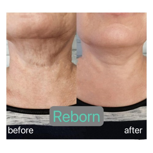 Reborn for Neck and Décolleté Rejuvenation