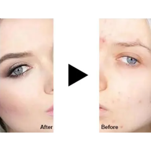 Skin Repair Product Used after Laser Treatment | Choicy Beauty- a beauty training academy