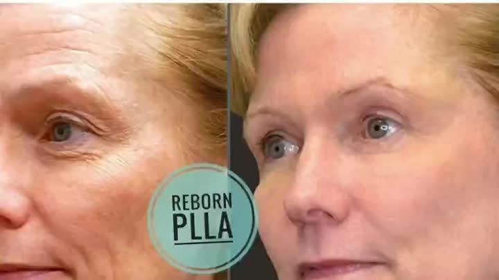 manufacturer supply hot selling plla dermal filler in facial aesthetics