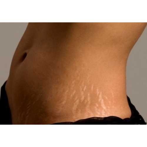 Stretch Marks Treatment | Choicy Beauty- a beauty training academy