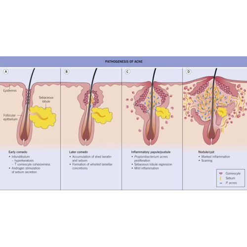 Acne Treatment | Choicy Beauty- a beauty training academic