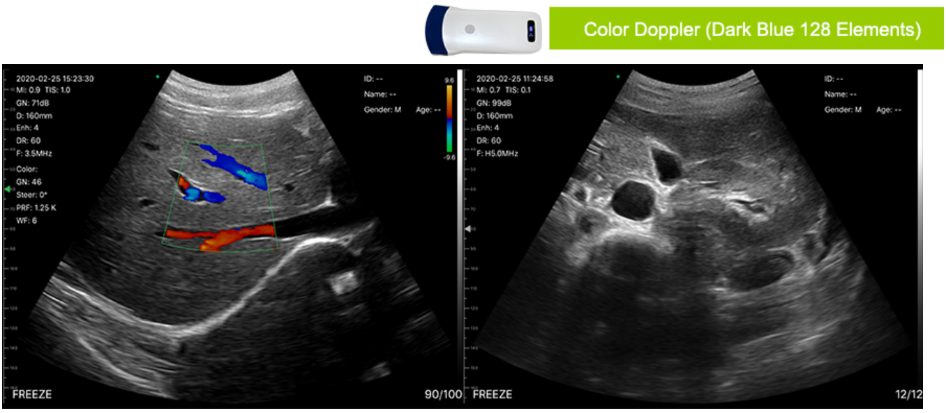 Pregnancy Poratble Ultrasonic 