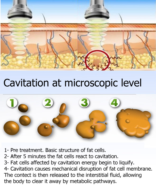 Choicy Cavitation RF Slimming Machine