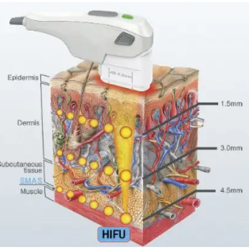 What's the Difference Between Ultherapy and HIFU