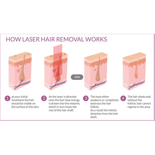 Laser vs. Waxing vs. Shaving – who wins finally? | Choicy Beauty- a beauty training academic   