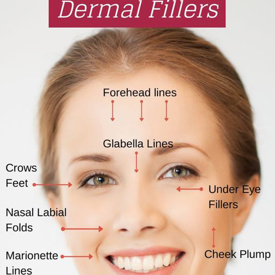 dermal filler