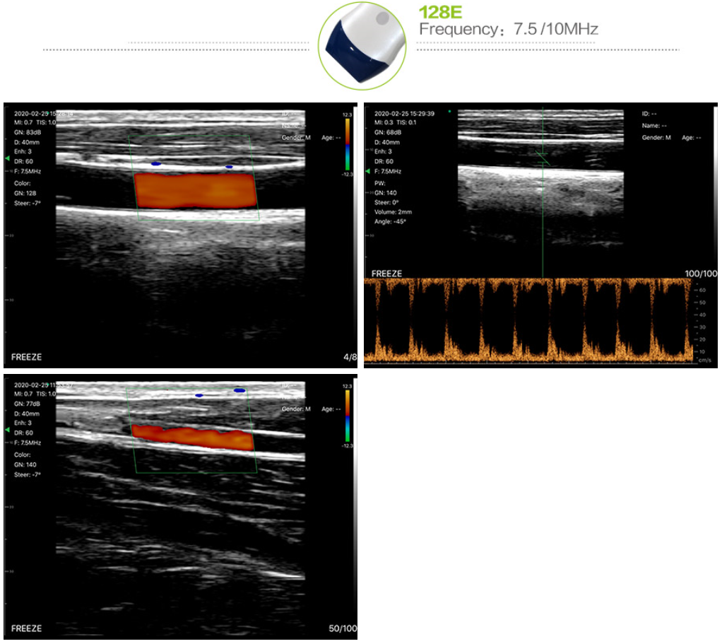 linear wireless ultrasound