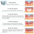 aesthetic sculptra polyl lactic filler face nasolabial folds