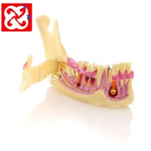 1/4 Mandible Pathology Anatomy Model: Caries, Impaction, and Abscess