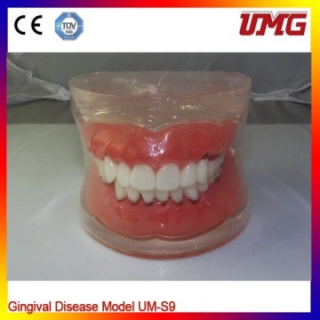 Dental Teaching Model for Gingival Disease Model